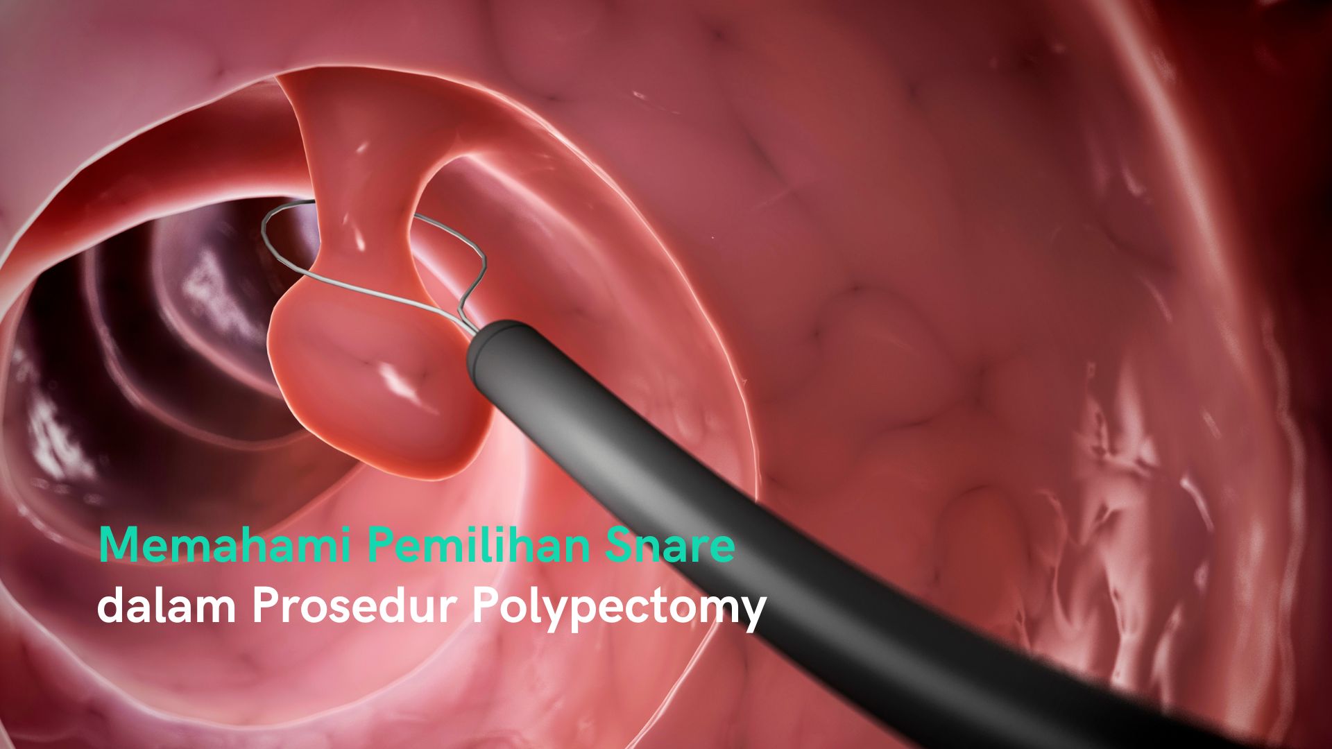 Memahami Pemilihan Snare dalam Prosedur Polypectomy